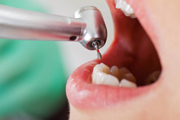 Best Emergency Tooth Extraction in St Bonaventure, NY